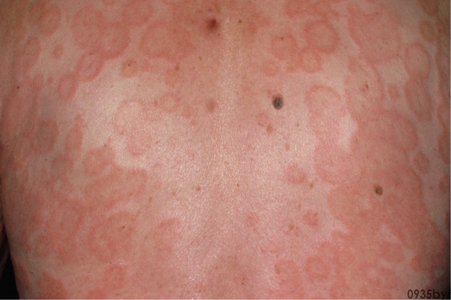 腰疼龟头有红斑包皮痒怎么办?(图1) 腰疼龟头有红斑包皮痒怎么办?