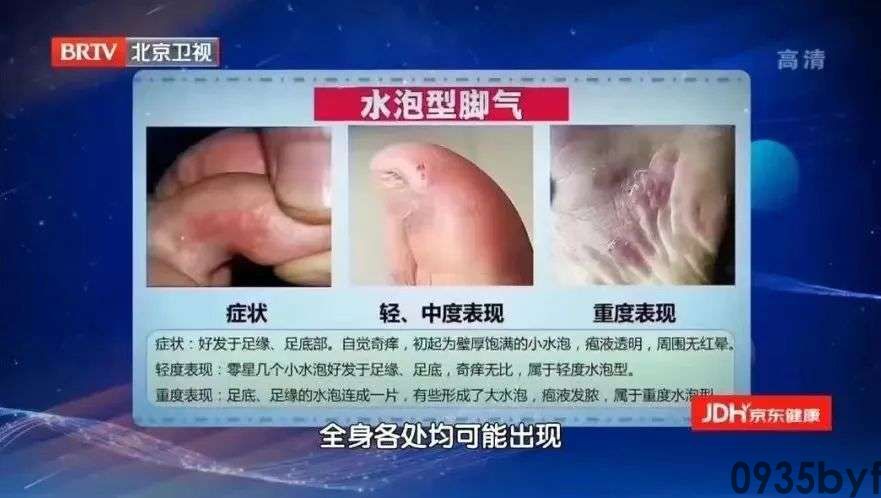 水泡型脚气的症状如何预防脚气