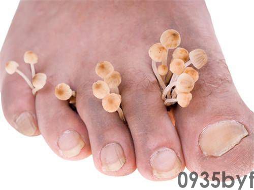 足部湿疹有哪些症状