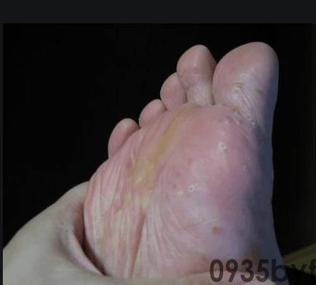 水泡型的足癣怎么治