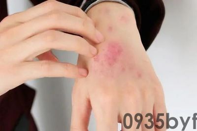 癣的症状图片-名医汇(图1) 癣的症状图片-名医汇(图1)