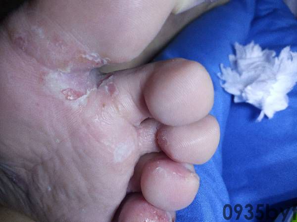 掌跖角化病会不会传染(图1) 掌跖角化病会不会传染