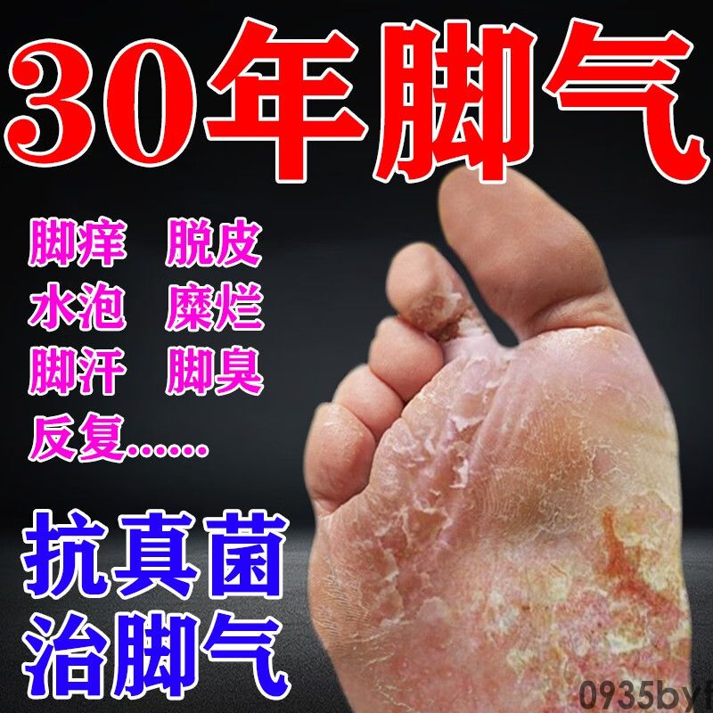 脚气为什么会脱皮(图1) 脚气为什么会脱皮