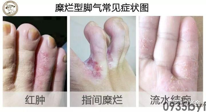 糜烂型足癣脚部有一块红斑有结痂图-有来医生(图1) 糜烂型足癣脚部有一块红斑有结痂图-有来医生