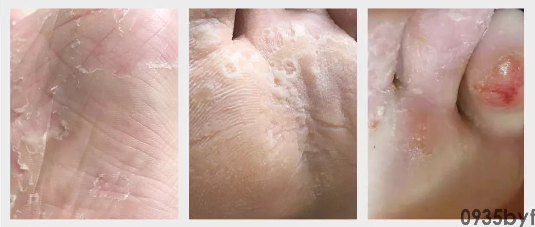 什么是皲裂性湿疹?(图1) 什么是皲裂性湿疹?