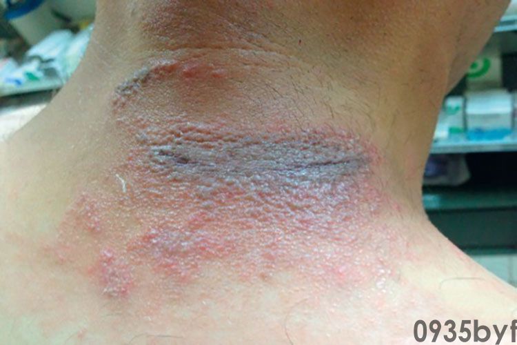 脚上长红色水泡很痒怎么回事