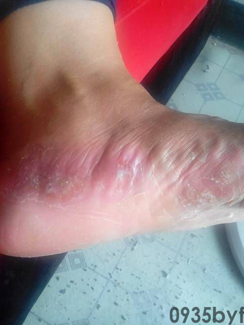 脚气的传染方式有哪些呢