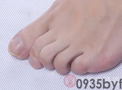 角化型脚癣是否最难治