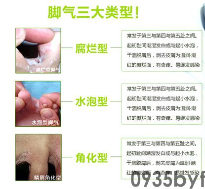 糜烂型脚气的治疗方法有哪些(图1) 糜烂型脚气的治疗方法有哪些