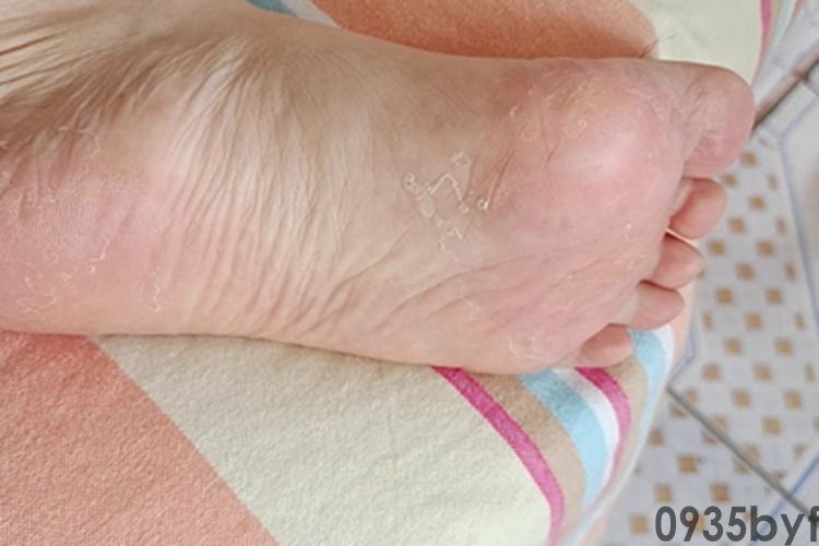 【图】角化型脚气怎么根治解读角化型脚气治疗方法