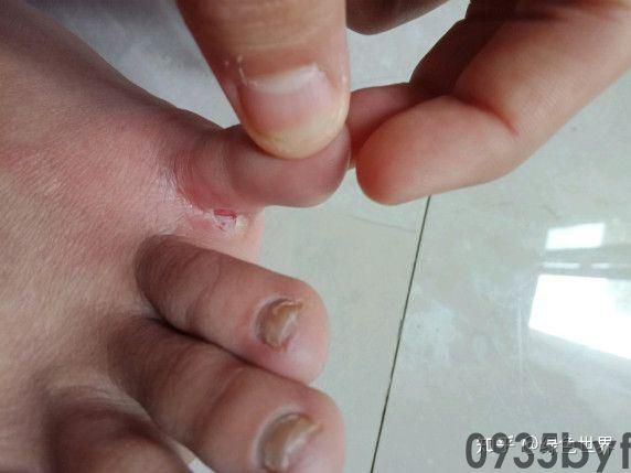 为什么脚气越挠越痒