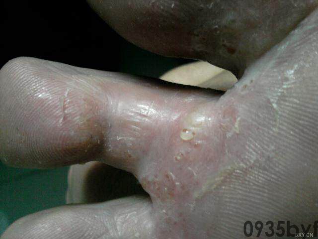 水泡型脚气的治疗方法有哪些(图1) 水泡型脚气的治疗方法有哪些