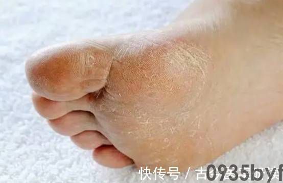 女生脚气的初期表现