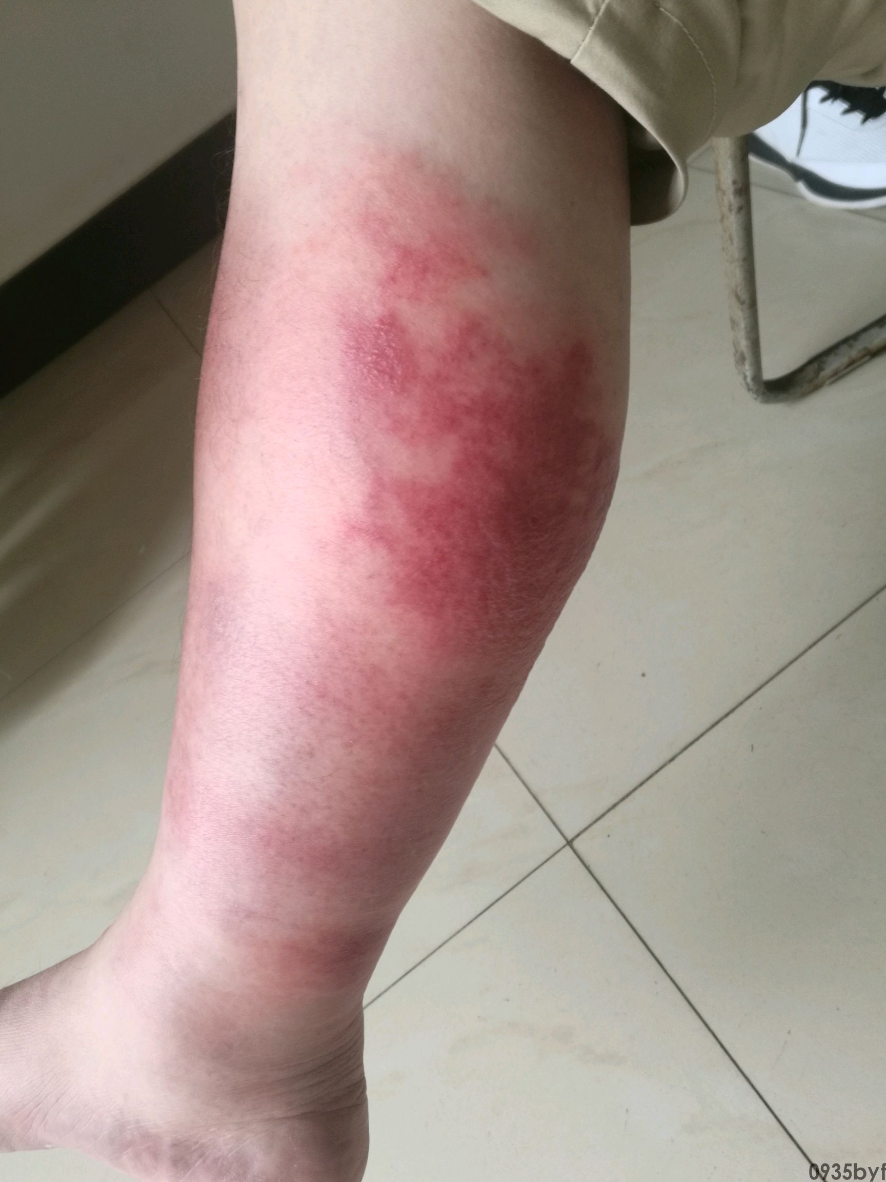 脚气感染的症状-有来医生(图1) 脚气感染的症状-有来医生