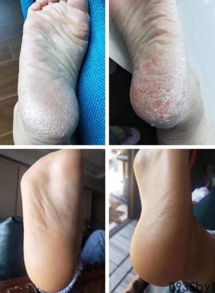 有什么治角化鳞屑型脚气的好药能介绍