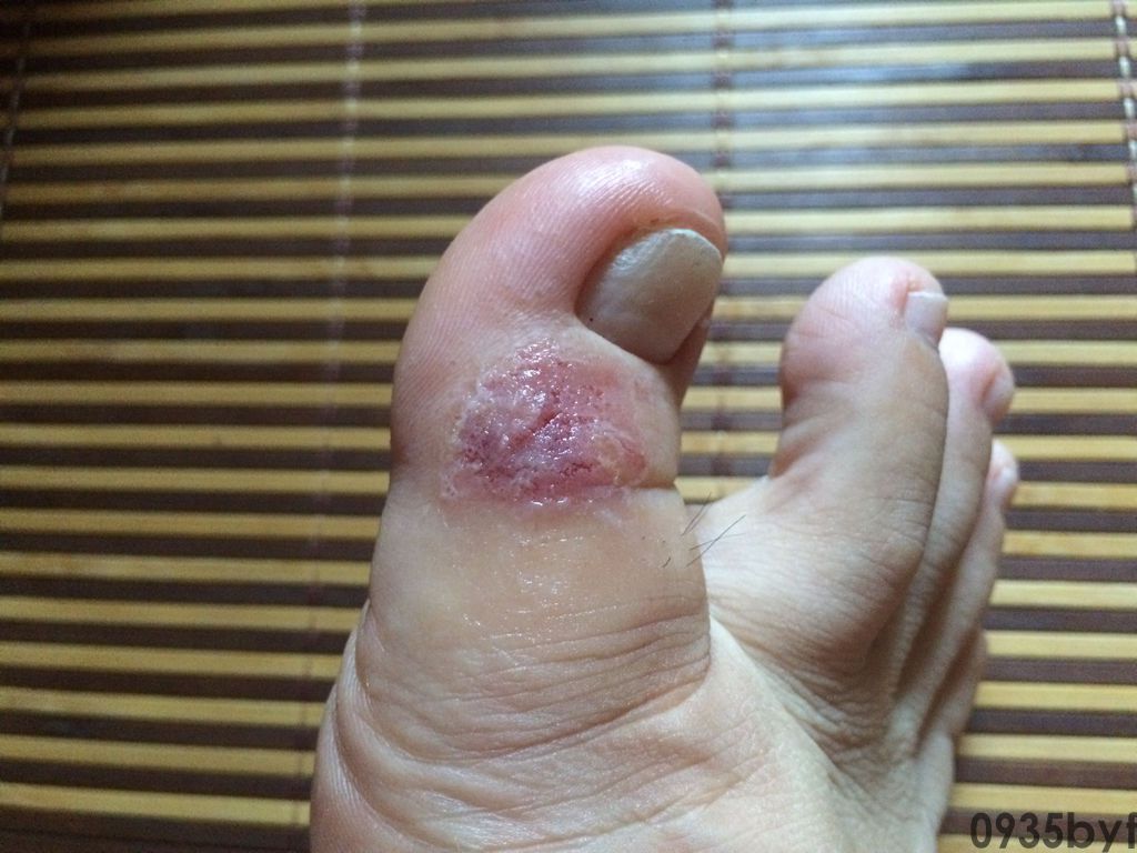 腐烂型脚气的症状是什么样的呢？