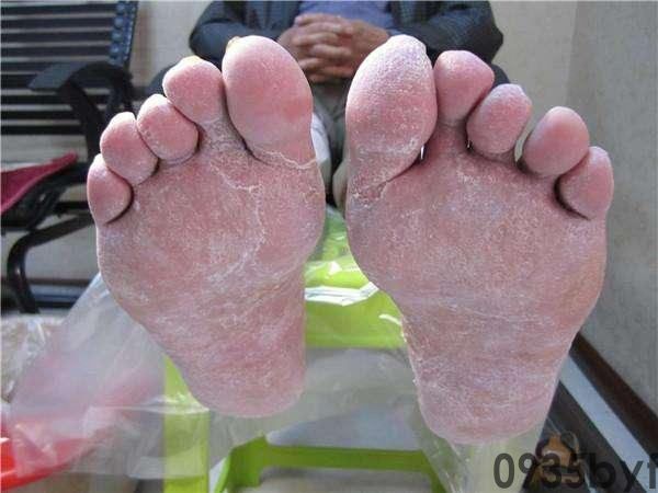 鳞屑型脚气的治疗方法