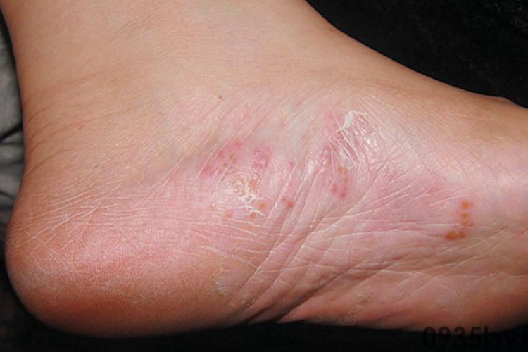 脚底起水泡什么引起的