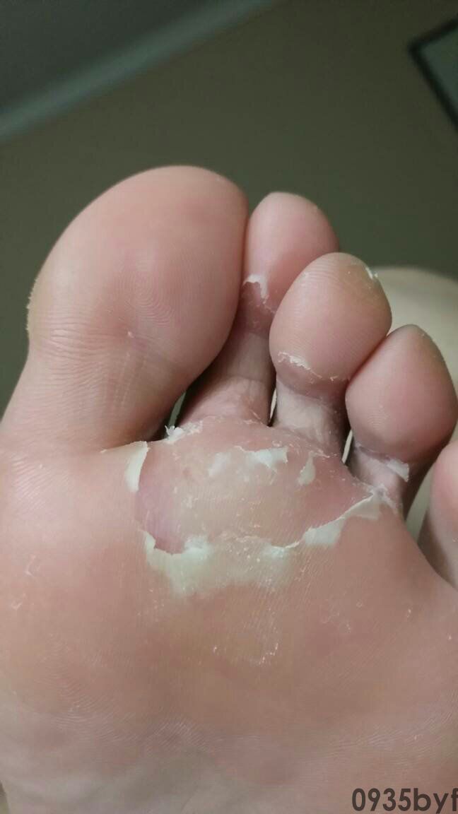 脚爆皮是脚气吗