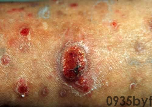 冬季取暖小心温暖伤害皮肤