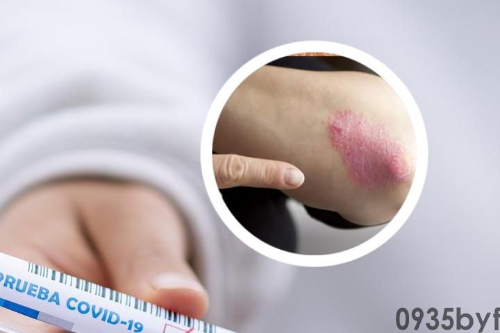 身上起了很多鳞屑比较痒怎么回事