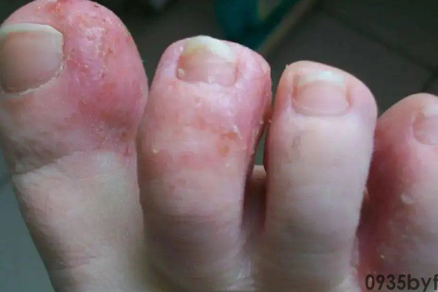 脚气出血了怎么办