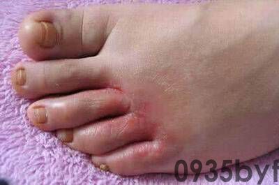 脚气大揭秘：你不知道的脚部健康秘密！