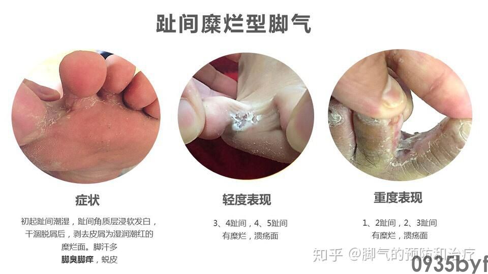 艾灸治疗皮肤癣菌病有效率100%