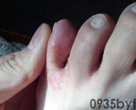 水泡糜烂型脚气根治方法