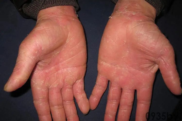 7岁女儿衣服与爸爸袜子混洗感染脚气身上长红斑水泡！医生：有人长在脸上引起毁容