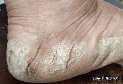 深层水泡型脚气怎么治能除根