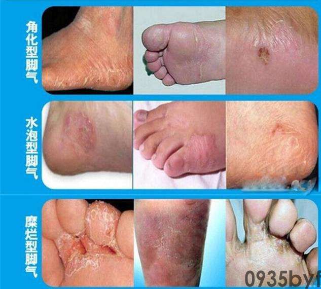 如何有效预防糜烂型脚气？