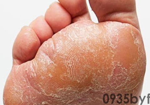 脚气脚臭脚痒怎么办？怎么治？