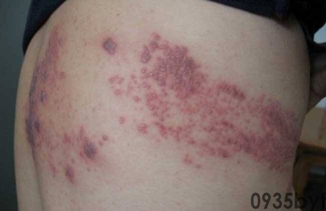 女儿衣服与爸爸袜子混洗后感染脚气而且大腿根出现红斑、脱屑和水泡医生提醒