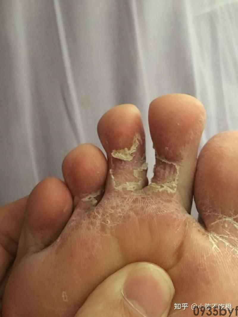 顽固性水泡型脚气怎么治疗