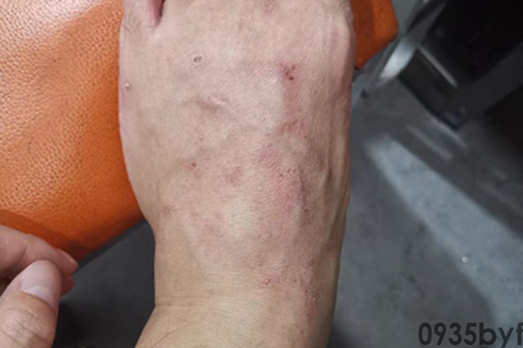 女儿衣服和爸爸袜子混洗后身上长红斑水泡！医生：严重可毁容