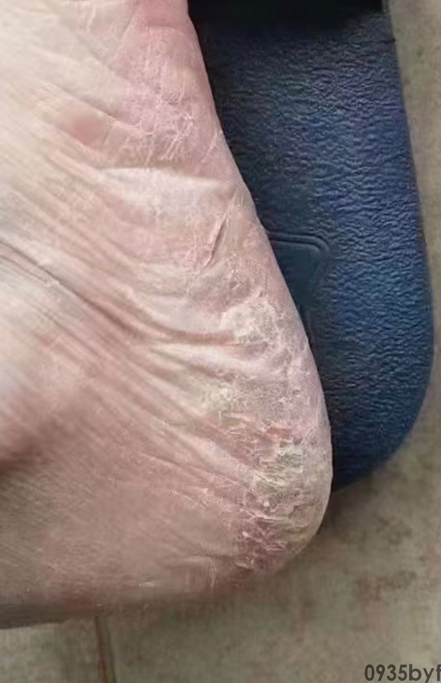 得了脚气的危害大吗？