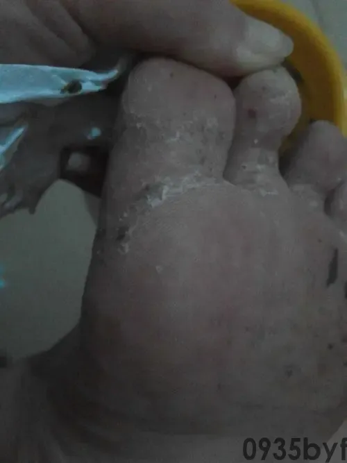 脚气早晨特痒快速止痒