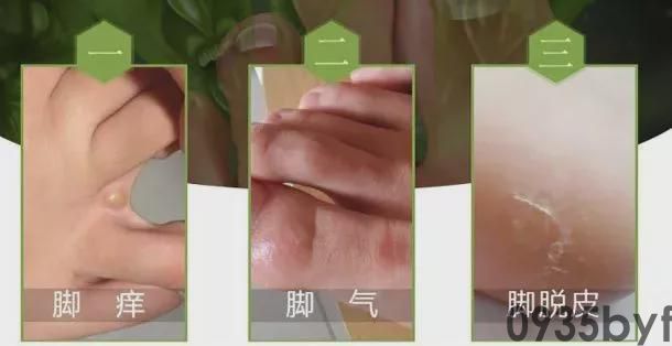 风行全欧洲的脚气水无色有趣20年香港脚也能救！(图3)