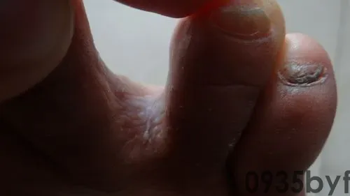 脚只是臭但脚不痒也不蜕皮