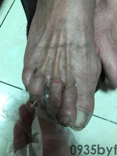 脱屑型脚癣有哪些病症？