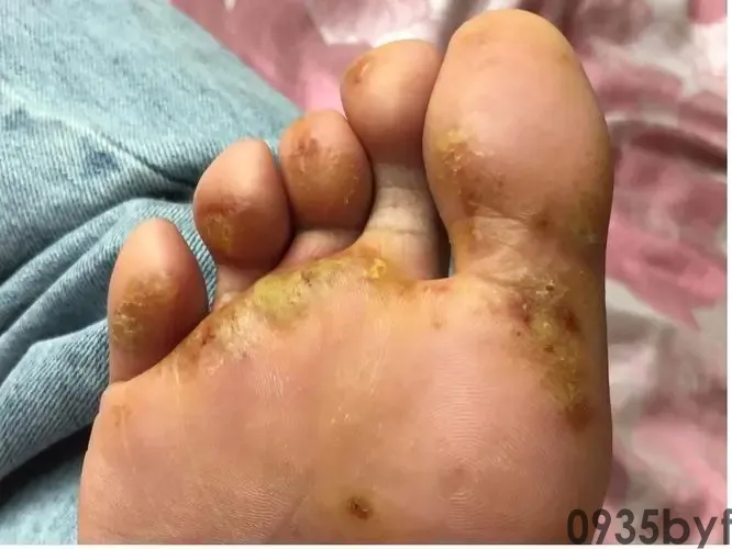 大人脚气有最有用的医治办法吗