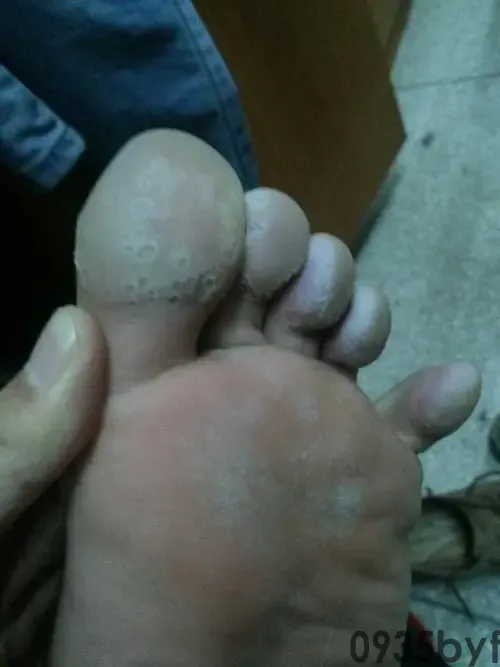 有脚气的人穿过的鞋子如何消毒