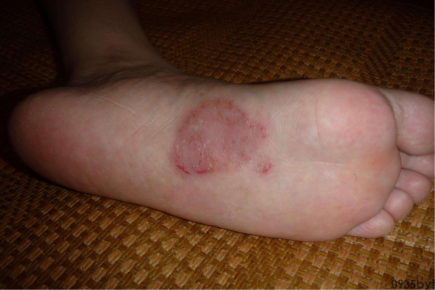 脚气腐败流水还能够洗脚吗(图1) 脚气腐败流水还能够洗脚吗