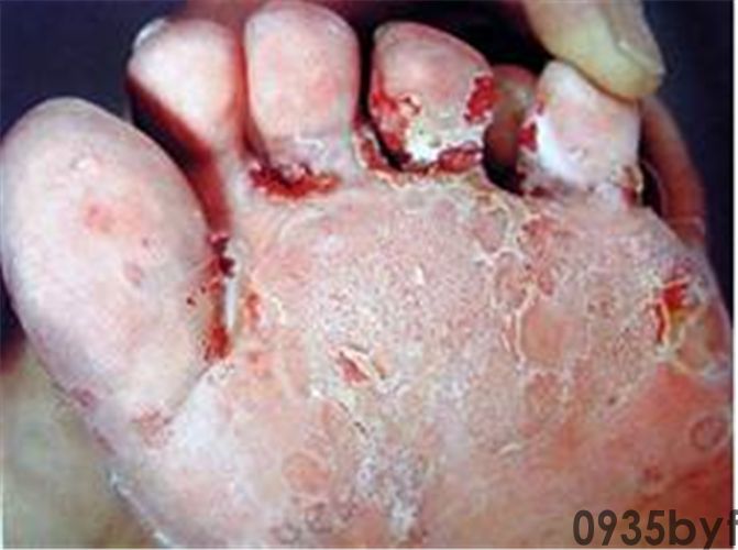 把擦脚巾当洗脸巾竟招致“脚气”上脸宁波27岁帅小伙惨绝人寰!大夫:一人传染可感染