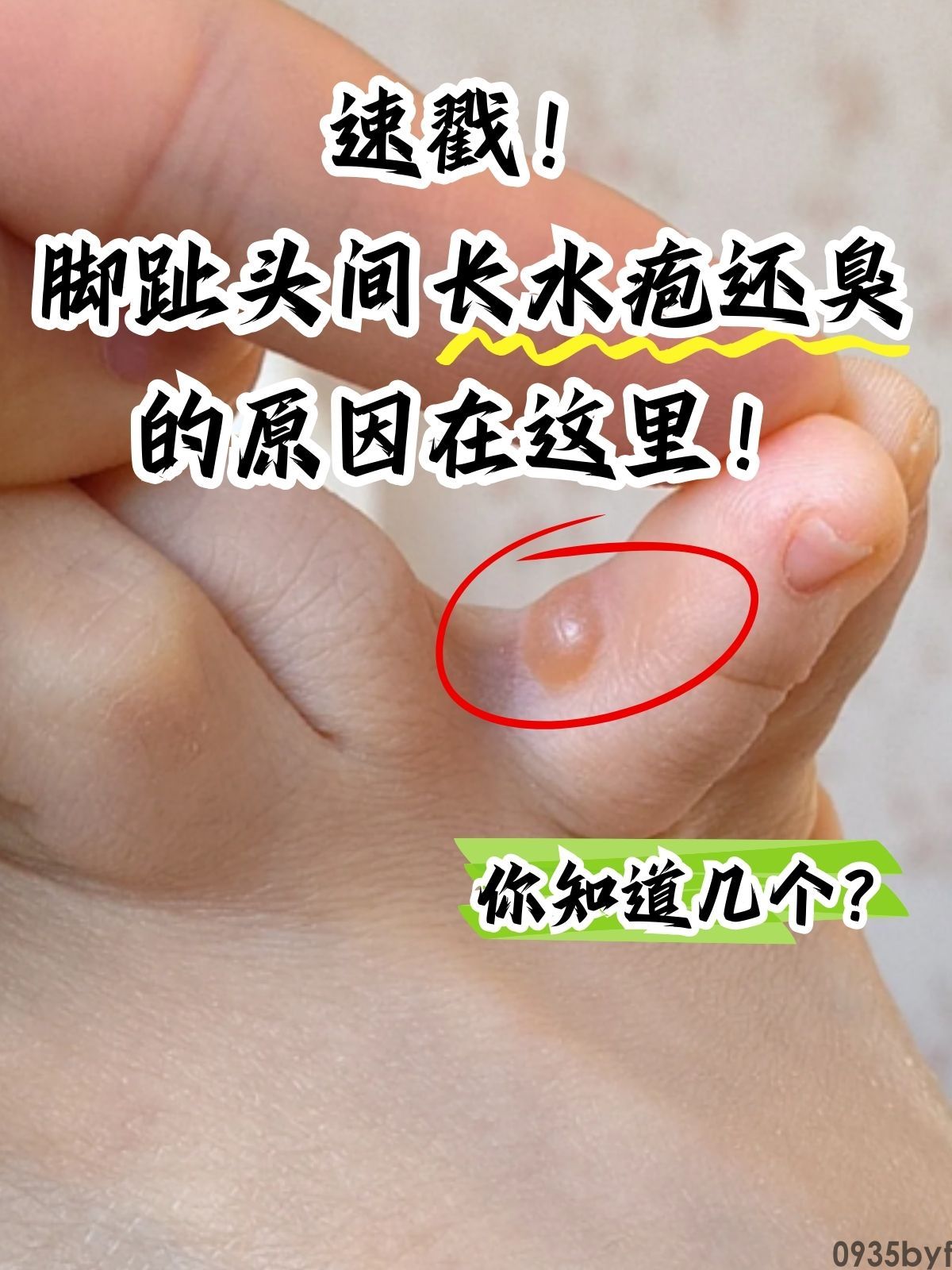 脚底脚气长水泡怎样办