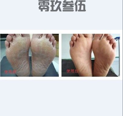 为何一只脚有脚气一只脚没有