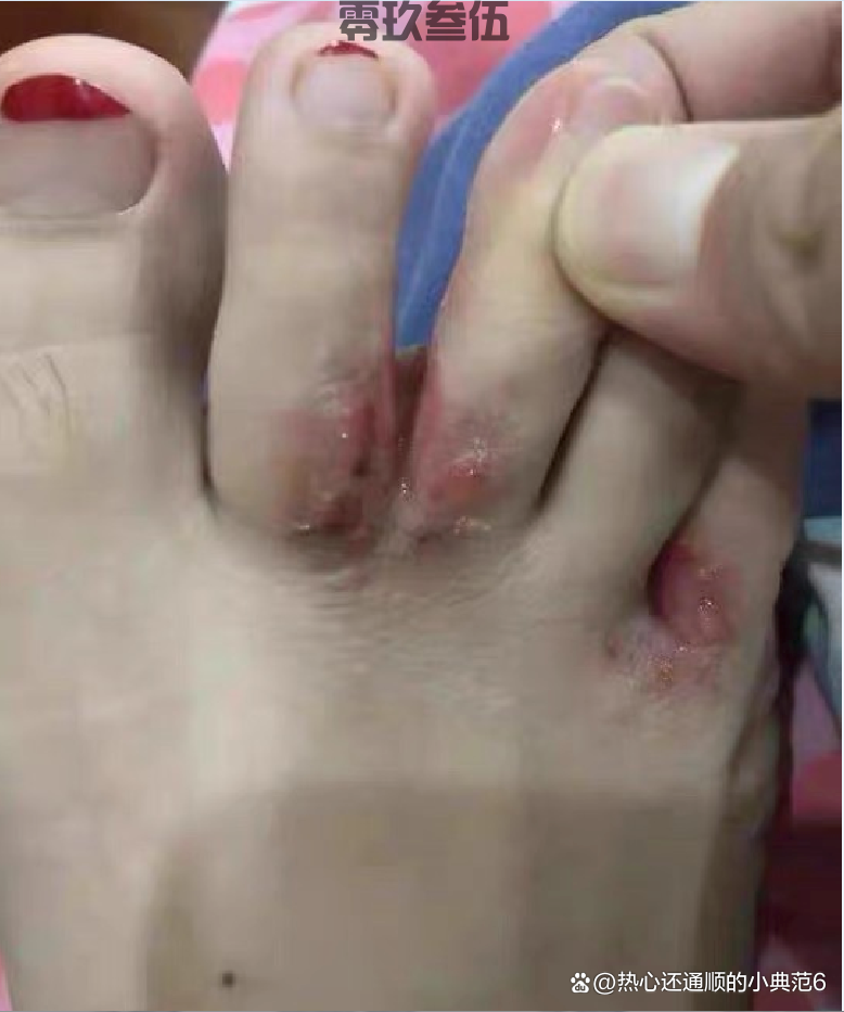 脚糜烂脱皮怎样医治