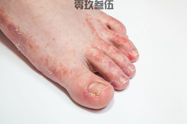 脚气鞋子怎样完全消毒