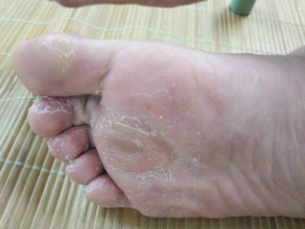 脚气烂脚指缝痒腐败用什么药膏